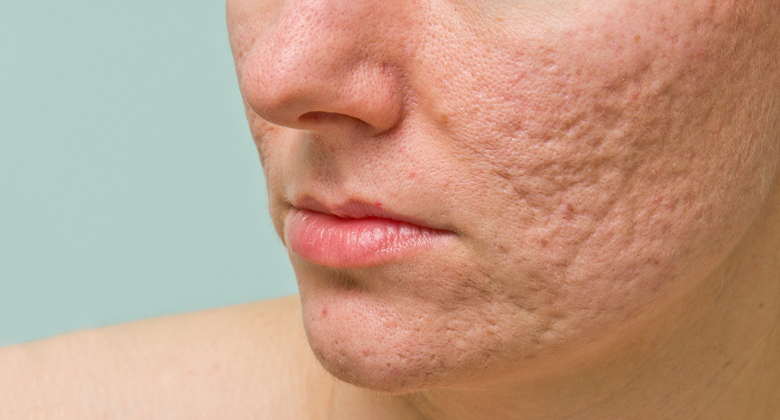 Acne Scars Las Consecuencias Del Acne Eucerin