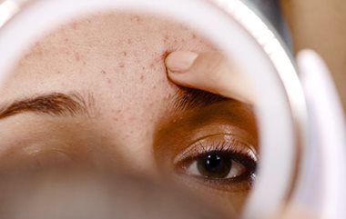 Acne treatment from a doctor