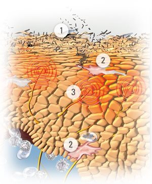 Ilustración de la piel con síntomas de Dermatitis Atópica